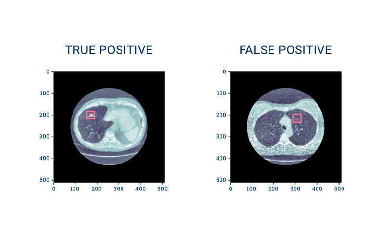 Medical Image Processing: True positives and false positives detected on CT scans